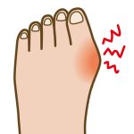 靭帯性外反母趾(じんたいせいがいはんぼし)