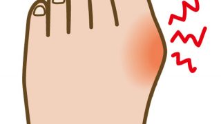 足・手・指の変形、外反母趾 13 【巻き爪・外反母趾情報】外反母趾・指の変形と痛み
